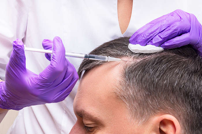 alopecia